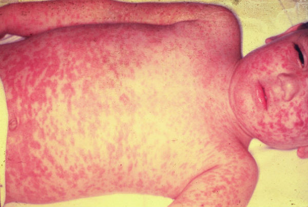 Europe must take action to prevent continued measles outbreak in 2012